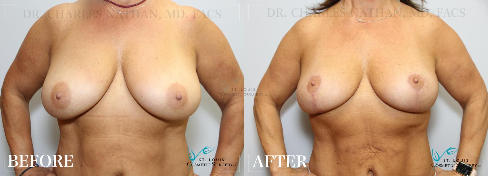 Before & After Breast Lift Case 266 Front View in St. Louis, MO