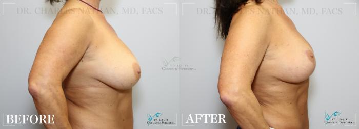 Before & After Breast Lift Case 266 Right Side View in St. Louis, MO