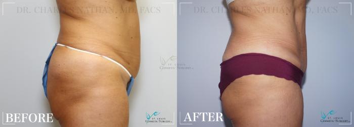 Before & After Tummy Tuck Case 266 Side-Abdominoplasty View in St. Louis, MO