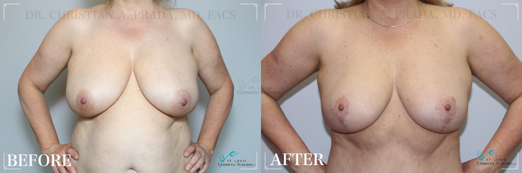 Before & After Breast Reduction Case 274 Front View in St. Louis, MO