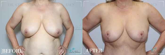 Before & After Breast Reduction Case 274 Front View in St. Louis, MO