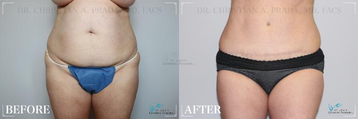 Before & After Mommy Makeover Case 274 Front- Tummy Tuck View in St. Louis, MO