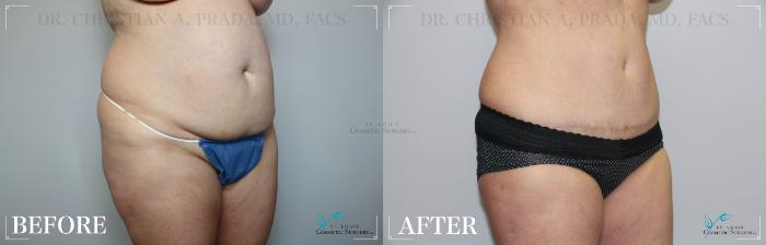 Before & After Mommy Makeover Case 274 Oblique- Tummy Tuck View in St. Louis, MO