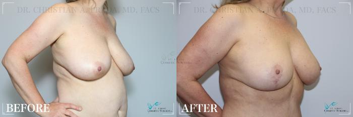 Before & After Breast Reduction Case 274 Right Oblique View in St. Louis, MO