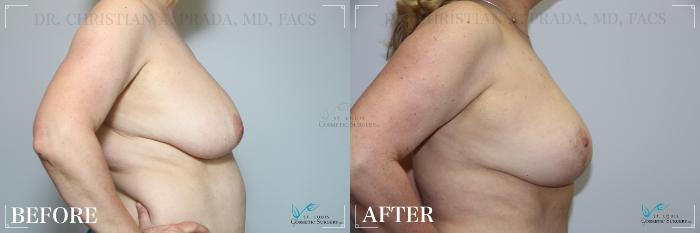Before & After Breast Reduction Case 274 Right Side View in St. Louis, MO