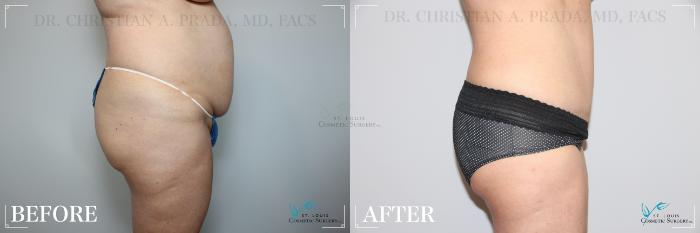 Before & After Breast Reduction Case 274 Side- Tummy Tuck View in St. Louis, MO