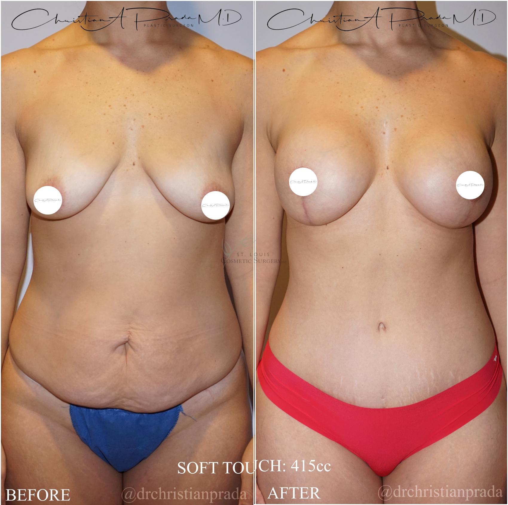 Before & After Breast Lift Case 371 Front View in St. Louis, MO