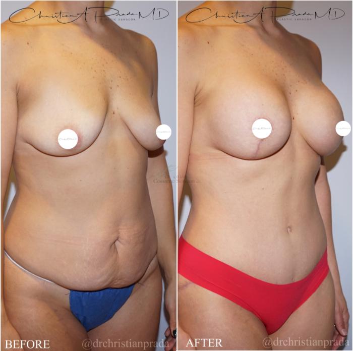 Before & After Mommy Makeover Case 371 Left Oblique View in St. Louis, MO