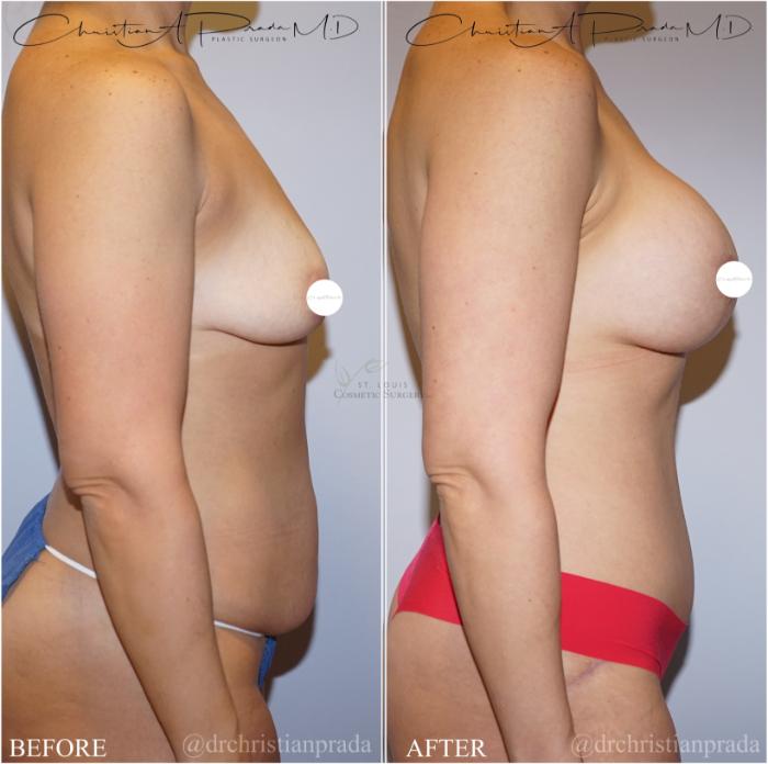 Before & After Breast Lift Case 371 Left Side View in St. Louis, MO