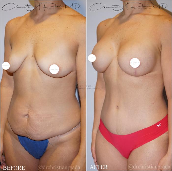 Before & After Breast Augmentation Case 371 Right Oblique View in St. Louis, MO