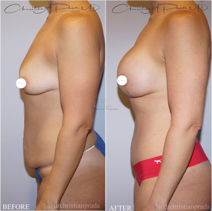 Before & After Breast Lift Case 371 Right Side View in St. Louis, MO