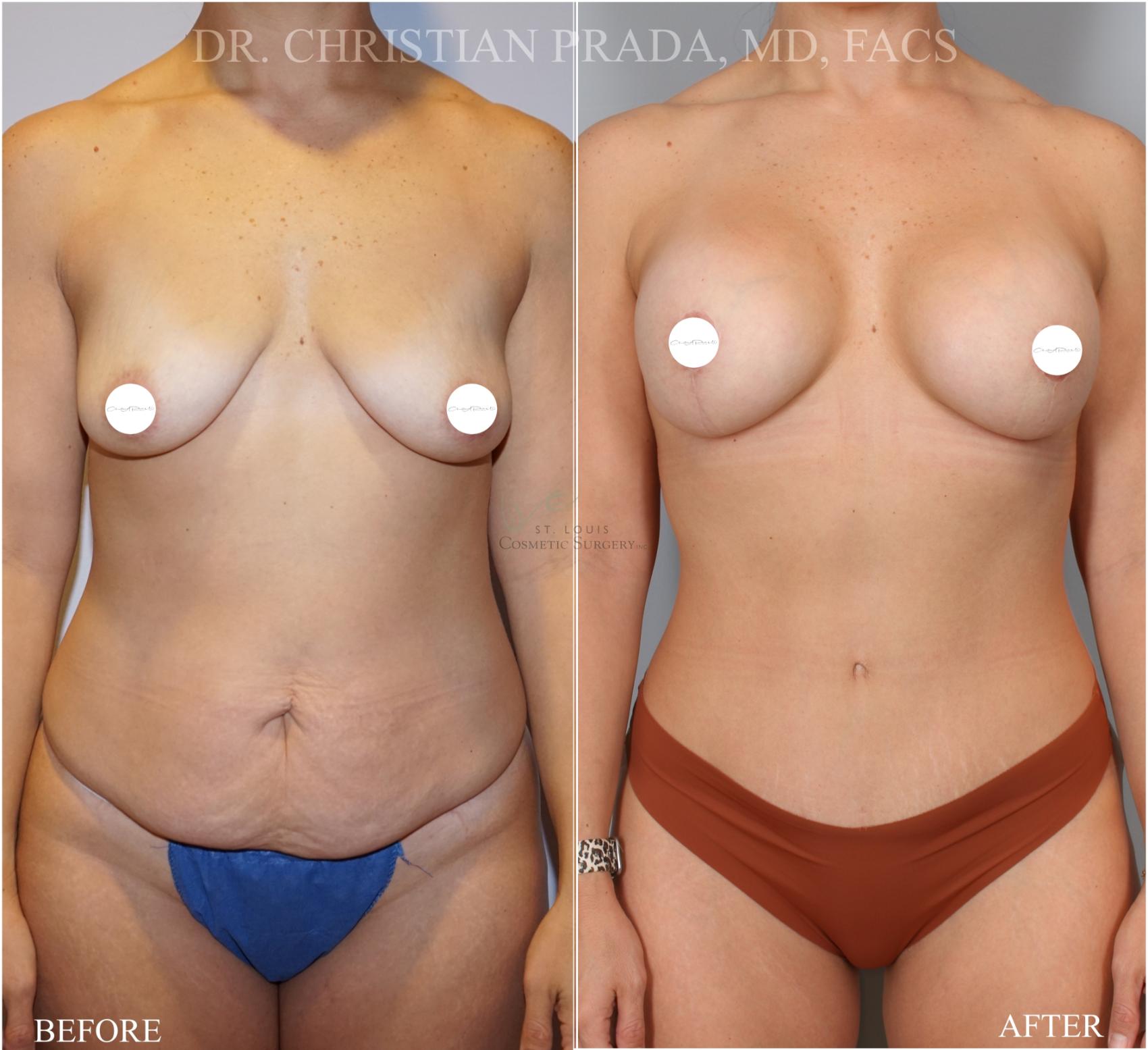 Before & After Tummy Tuck Case 372 Front View in St. Louis, MO