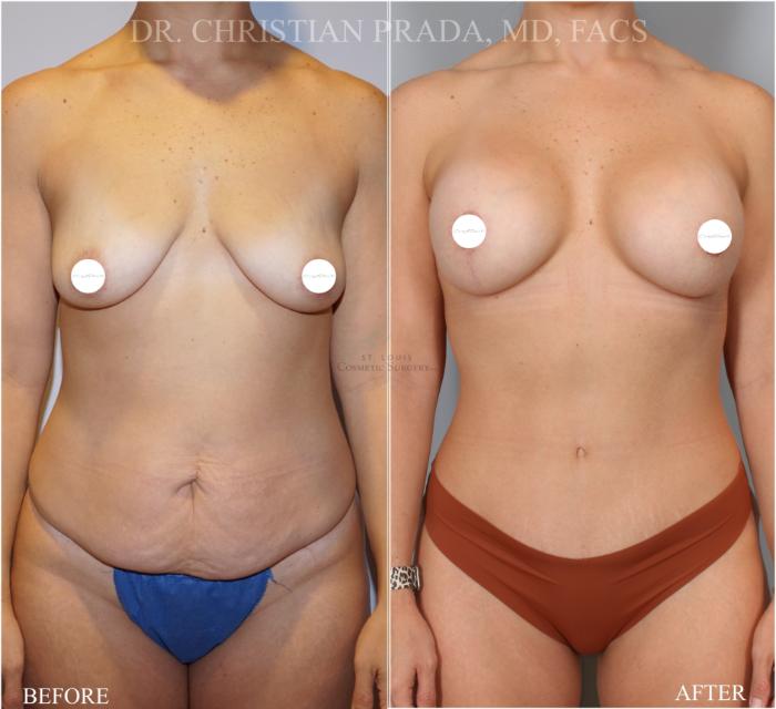 Before & After Breast Augmentation Case 372 Front View in St. Louis, MO