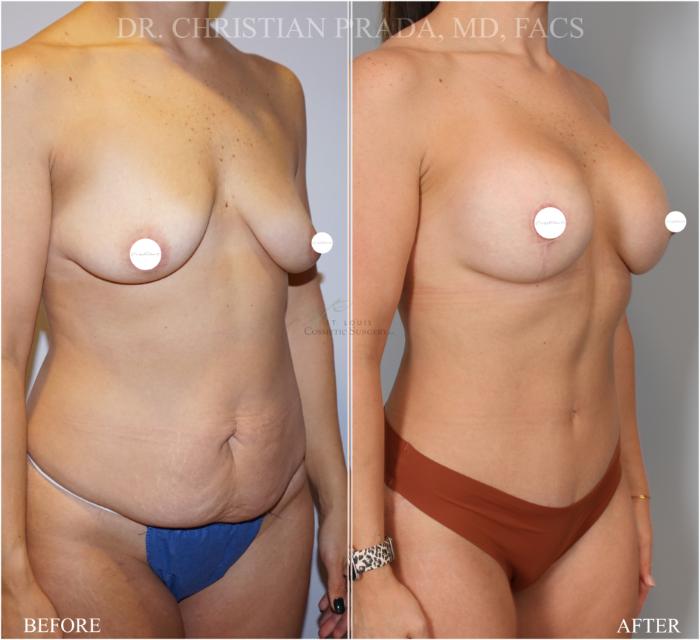 Before & After Tummy Tuck Case 372 Left Oblique View in St. Louis, MO