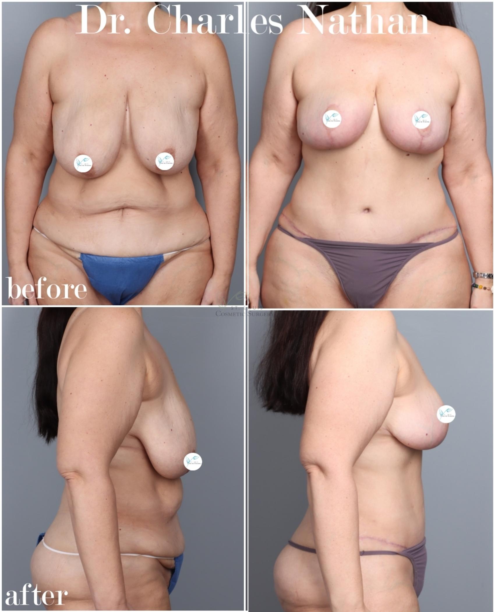 Before & After Mommy Makeover Case 446 Front View in St. Louis, MO