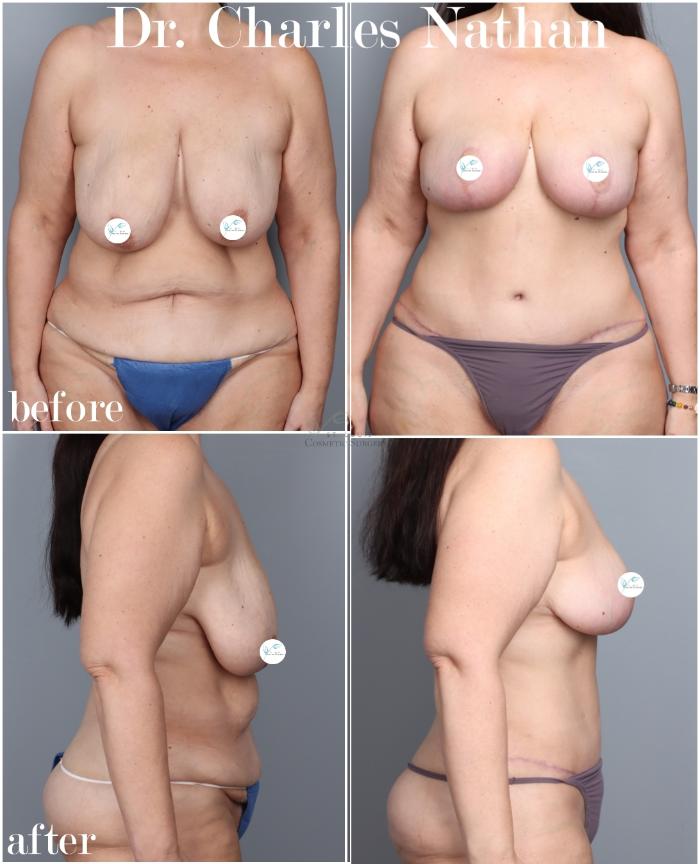 Before & After Mommy Makeover Case 446 Front View in St. Louis, MO