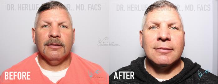 Before & After Neck Lift Case 160 Front View in St. Louis, MO