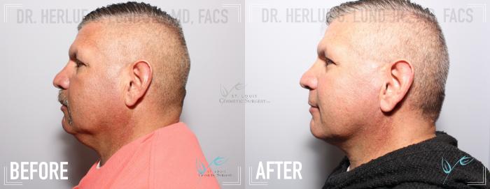 Before & After Neck Lift Case 160 Left Side View in St. Louis, MO