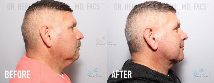 Before & After Neck Lift Case 160 Right Side View in St. Louis, MO