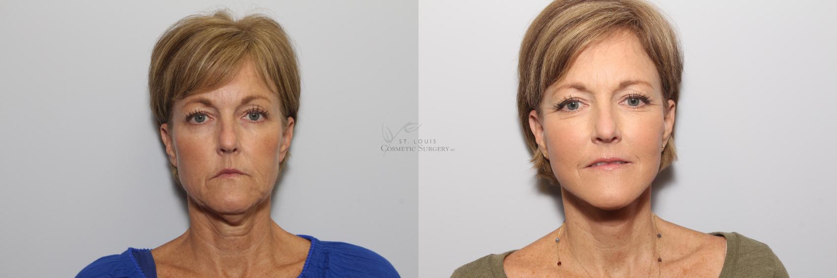 Neck Lift Before & After Photo | St. Louis, MO | St. Louis Cosmetic Surgery