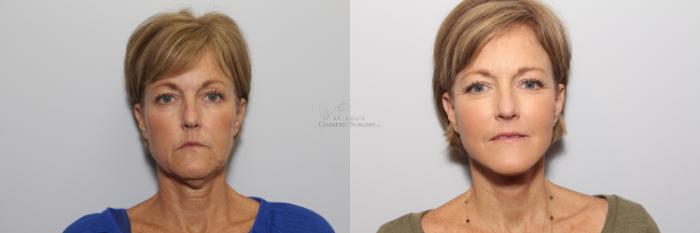 Before & After Neck Lift Case 72 View #1 View in St. Louis, MO