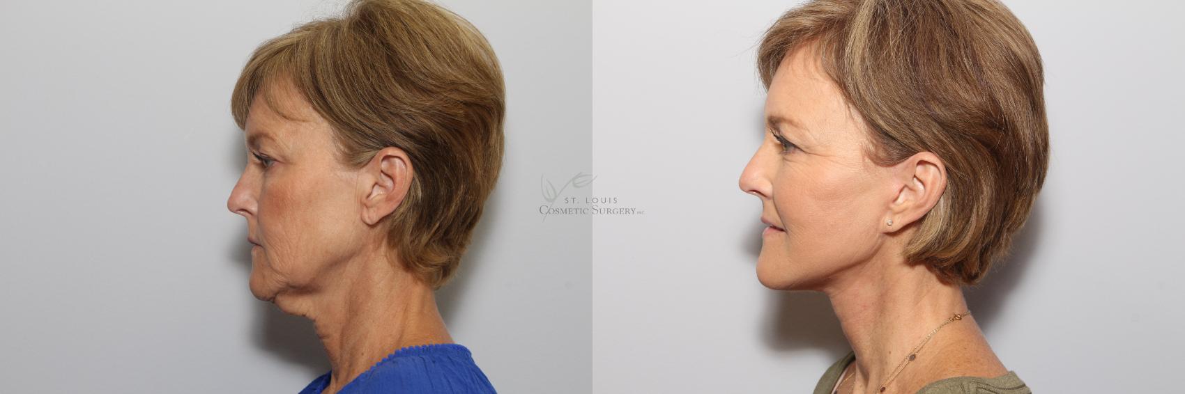 Neck Lift Before & After Photo | St. Louis, MO | St. Louis Cosmetic Surgery