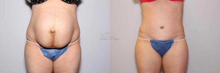 Before & After Tummy Tuck Case 102 View #1 View in St. Louis, MO