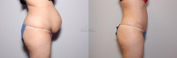 Before & After Tummy Tuck Case 102 View #2 View in St. Louis, MO