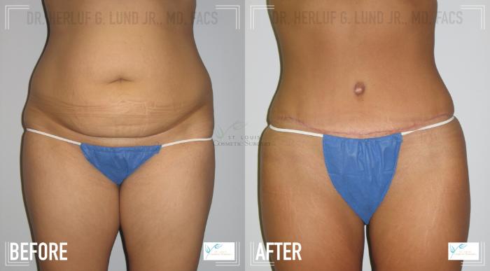 Before & After Tummy Tuck Case 117 Front View in St. Louis, MO