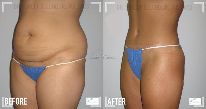 Before & After Tummy Tuck Case 117 Left Oblique View in St. Louis, MO
