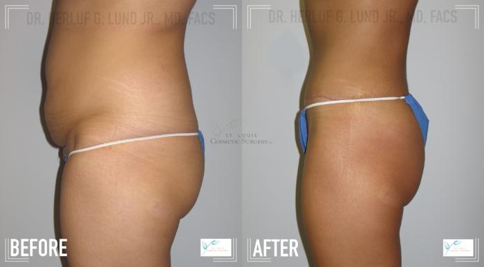 Before & After Tummy Tuck Case 117 Left Side View in St. Louis, MO