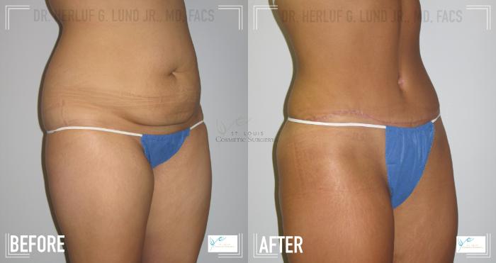 Before & After Tummy Tuck Case 117 Right Oblique View in St. Louis, MO