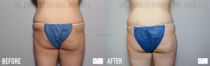Before & After Tummy Tuck Case 118 Back View in St. Louis, MO