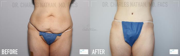 Before & After Tummy Tuck Case 118 Front View in St. Louis, MO