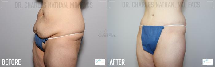 Before & After Tummy Tuck Case 118 Left Oblique View in St. Louis, MO
