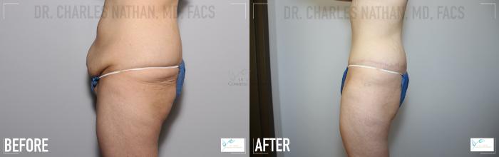 Before & After Tummy Tuck Case 118 Left Side View in St. Louis, MO