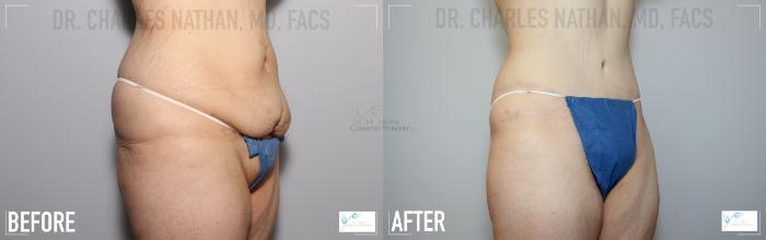 Before & After Tummy Tuck Case 118 Right Oblique View in St. Louis, MO