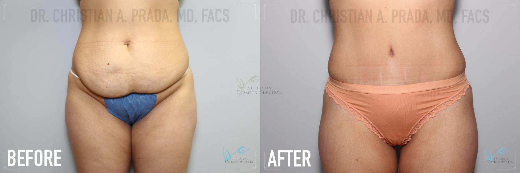 Before & After Tummy Tuck Case 126 Front View in St. Louis, MO
