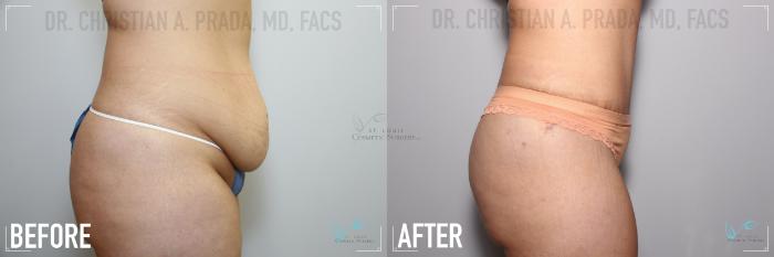 Before & After Tummy Tuck Case 126 Right Side View in St. Louis, MO