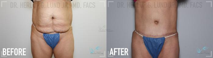 Before & After Tummy Tuck Case 135 Front View in St. Louis, MO