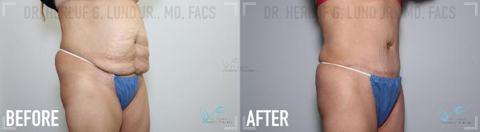 Before & After Liposuction Case 135 Right Oblique View in St. Louis, MO
