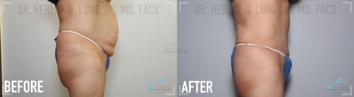 Before & After Tummy Tuck Case 135 Right Side View in St. Louis, MO