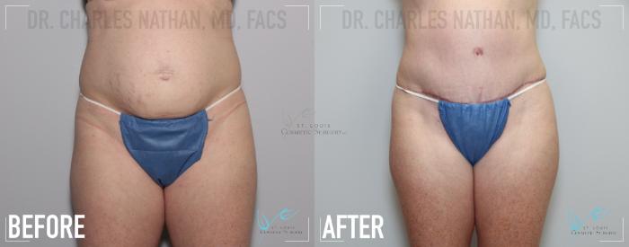Before & After Tummy Tuck Case 139 Front View in St. Louis, MO