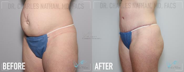 Before & After Tummy Tuck Case 139 Left Oblique View in St. Louis, MO