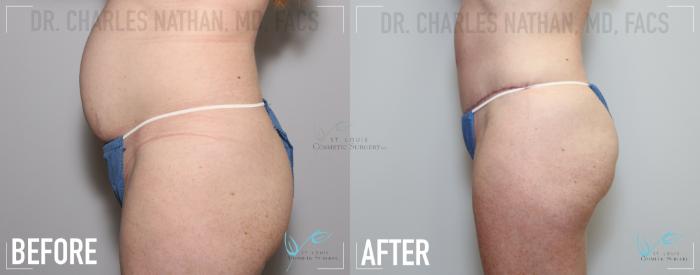 Before & After Tummy Tuck Case 139 Left Side View in St. Louis, MO