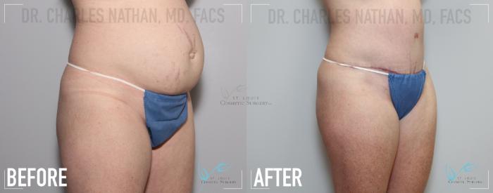 Before & After Tummy Tuck Case 139 Right Oblique View in St. Louis, MO