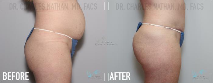 Before & After Tummy Tuck Case 139 Right Side View in St. Louis, MO