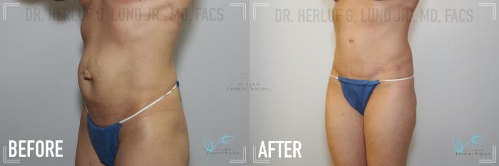 Before & After Tummy Tuck Case 146 Left Oblique View in St. Louis, MO