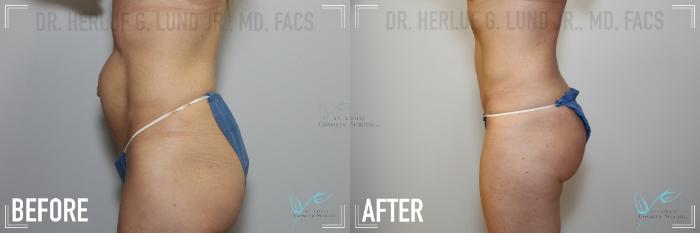 Before & After Tummy Tuck Case 146 Left Side View in St. Louis, MO