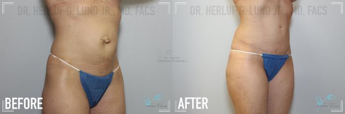 Before & After Tummy Tuck Case 146 Right Oblique- Abdominoplasty View in St. Louis, MO